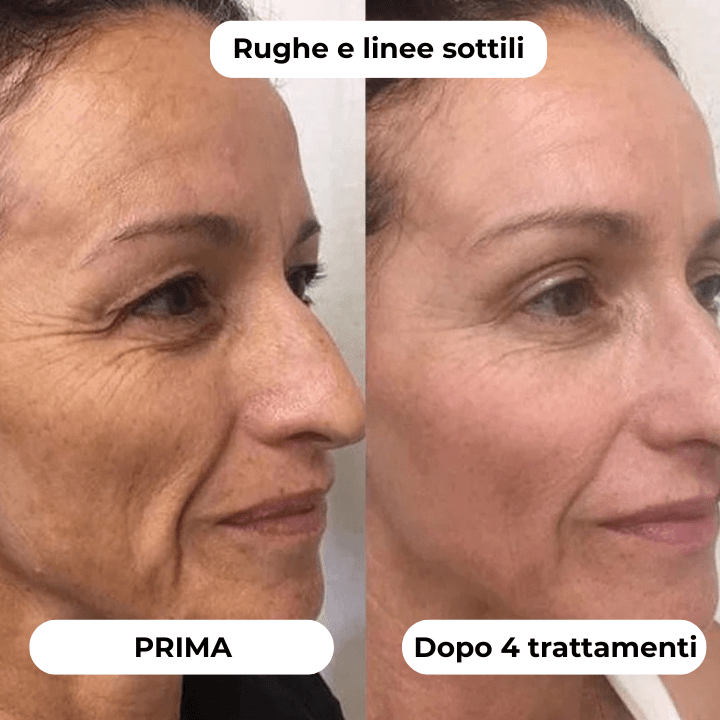 DermaGlow + | Sistema di Microinfusione - ONDIVO