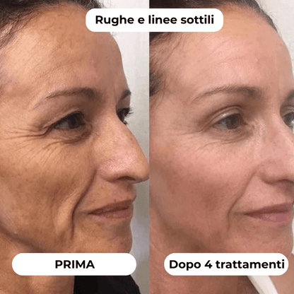 DermaGlow + | Sistema di Microinfusione - ONDIVO
