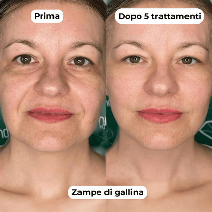 DermaGlow + | Sistema di Microinfusione - ONDIVO